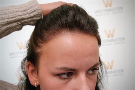 Female Hair Transplant Before And After Results