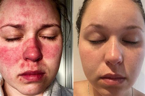 Rosacea symptoms: Woman with skin condition that made it ‘agony’ to ...