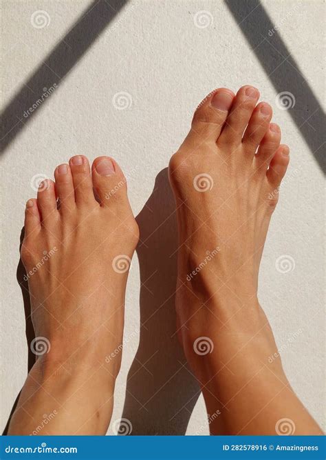 Woman Feet with Hallux Valgus, Bunion, Bony Bump. Stock Photo - Image