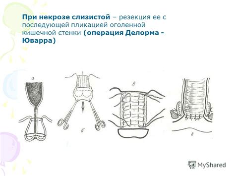 Презентация на тему: "Выпадение прямой кишки Prolapsus recti 0,3 – 5,2% ...