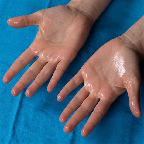 Хиперхидроза. Лечение на обилно потене. Цена - Dr. Stavrov Aesthetics