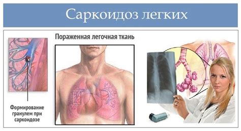 Саркоидоз - признаки, причины, симптомы, лечение и профилактика ...