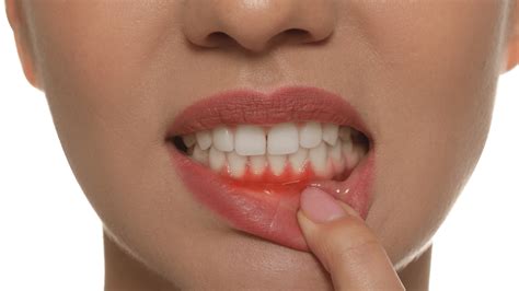 guide  early signs  gum disease treatment
