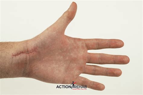 Scar Management for Hand Injuries & Surgeries