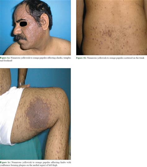 A new presentation of isolated cutaneous Rosai-Dorfman disease