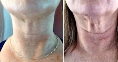 Get Rid of Turkey Neck: How I Tightened Saggy Skin At-Home. Pictures