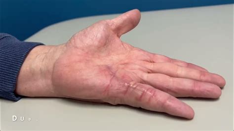 Dupuytren's Contracture Before and After Surgery - YouTube