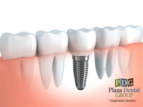Depression Drugs Are Fatal for Dental Implants- A Study | Plaza Dental