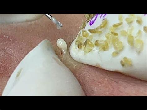 Loan Nguyen Acne (#078) - YouTube | Acne, Blackheads popping, Loan