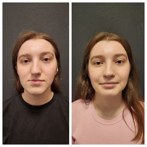 Know About Double Jaw Surgery Before and After