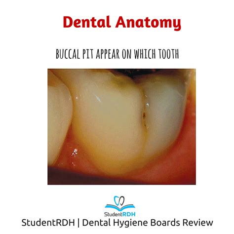 Which tooth has a buccal pit? - StudentRDH Blog