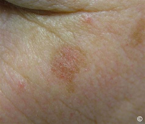 actinic keratosis solar keratosis