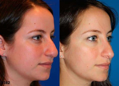top common nose shapes   philip miller md