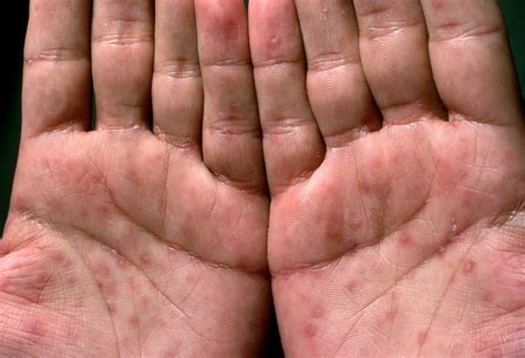 11 Syphilis Symptoms in Women - Syphilis Stages & Signs