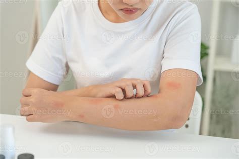 skin problem and beauty woman scratch body has itchy skin from skin