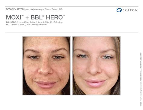 BBL Hero — Bloom Skin Aesthetics