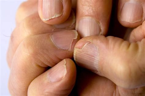 Brittle Nails causes and treatments - aleecare