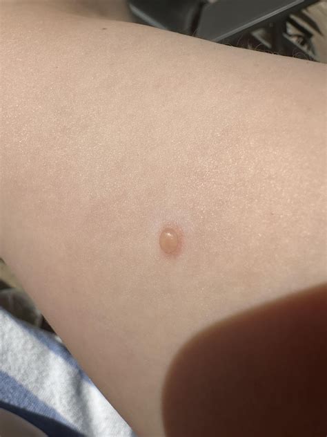 Temptation blister randomly appears on arm : r/popping