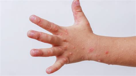 hand foot  mouth disease  head store emergencydentistrycom