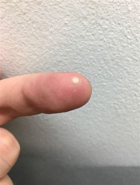 White dot on my finger under a few layers of skin, thought it was a