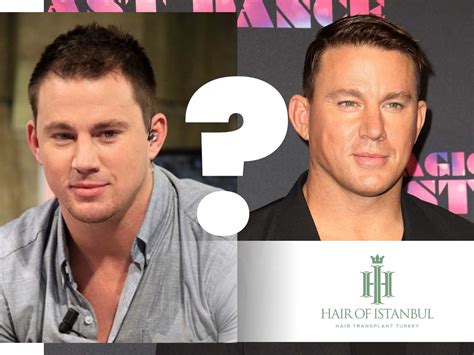 Channing Tatum Hair Transplant: The Untold Transformation Tale