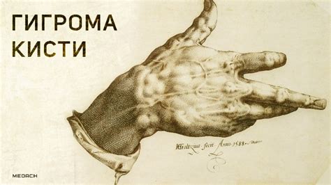 Гигрома кисти