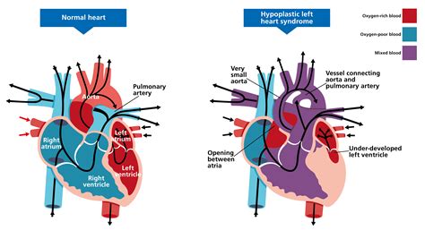 Hypoplastic Left Heart Syndrome Wikipedia Collaboratively Charting The