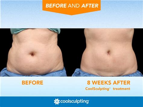 microcurrent body sculpting before and after - lizarragafaruolo