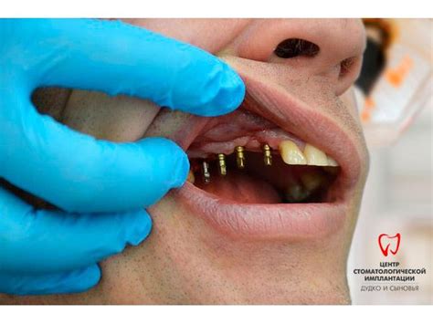 Basal Dental Implant – Dental clinic – dental- News