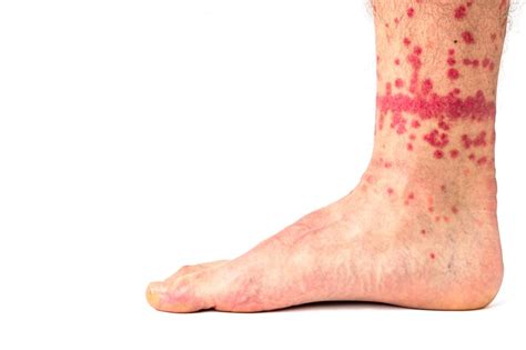Flea Bites On Thighs
