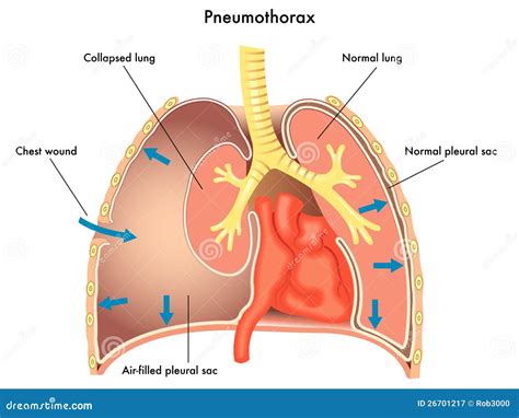 Pneumothorax Cartoon Vector | CartoonDealer.com #47808847