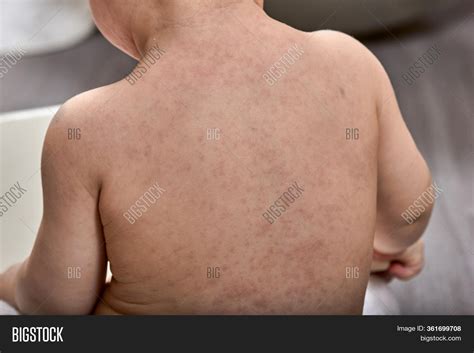 Roseola Rash Viral Image & Photo (Free Trial) | Bigstock