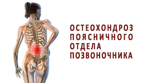 Что нужно знать об остеохондрозе поясничного отдела - YouTube