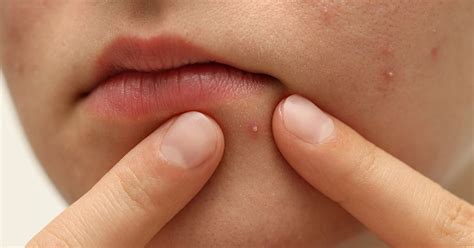 pustules  identification  treatments