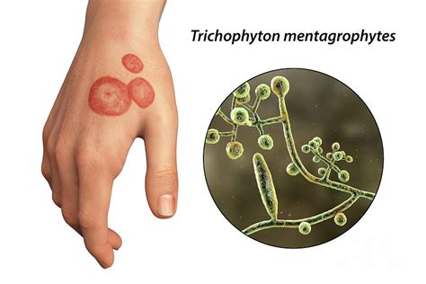 Ringworm Photograph by Kateryna Kon/science Photo Library - Fine Art ...