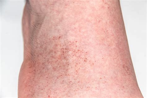 ruam merah  kaki lakilaki  latar belakang closeup bagian kaki