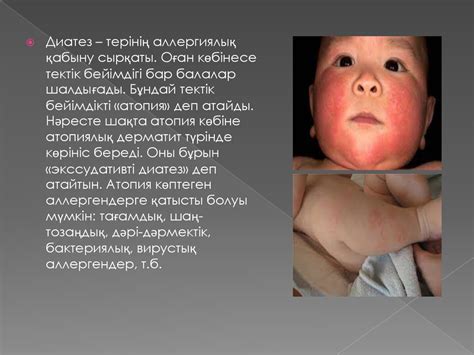 Балалардағы диатез - презентация онлайн