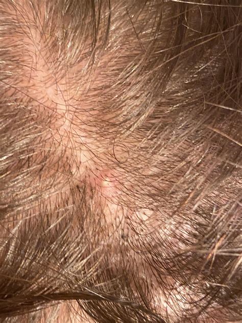 Hair loss and bumps on scalp. Has anyone experienced something similar ...