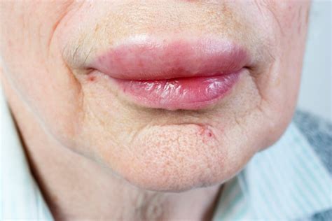 Lábio Inchado E Dormente - 12 causas de los labios hinchados - Mejor con Salud