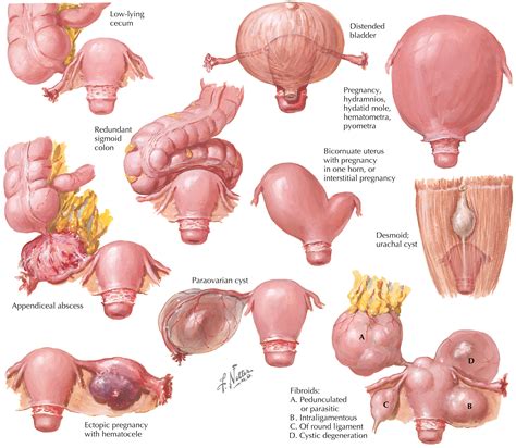 Pelvic Masses - Clinical Tree