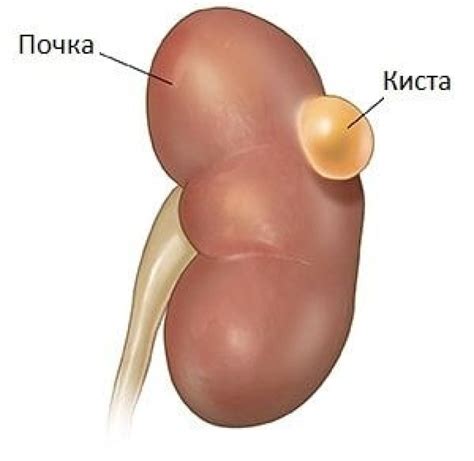 Что такое субкапсулярная киста почки