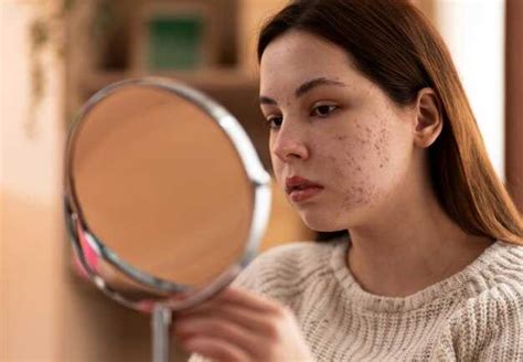 Прыщи на лице от сладкого: причины, методы лечения и профилактика