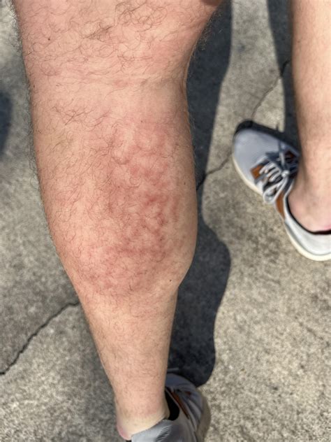 Strange marks on calf muscle skin after leg days in the gym. Not