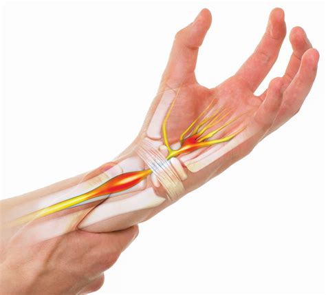 understanding carpal tunnel syndrome read  story  magztercom