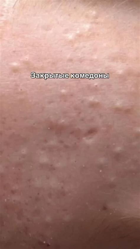 Для кожи | Лечение прыщей, Лечение акне, Советы для здоровья кожи