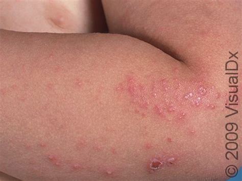 scabies pediatric condition treatments  pictures  children