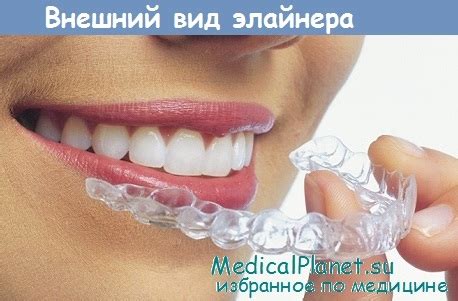 Какие невидимые брекеты существуют и сколько они стоят?