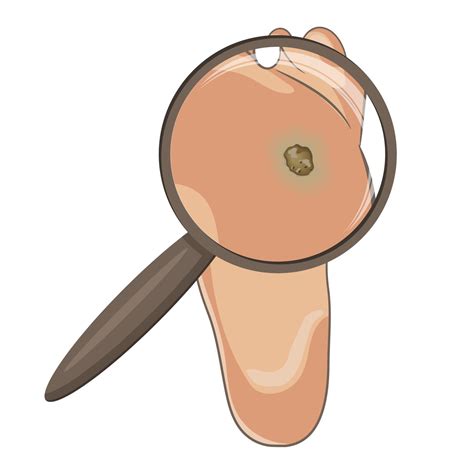 Foot wart magnified with glass. Foot bottom pathology, verruca, wart