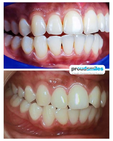 Proud Smiles Dental - Gum bleaching, also known as depigmentation, is a