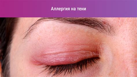 Аллергия на косметику: всё о лечении и препаратах